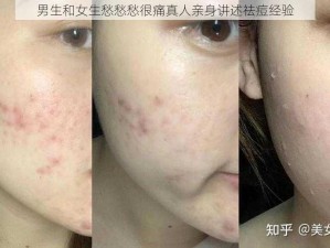 男生和女生愁愁愁很痛真人亲身讲述祛痘经验